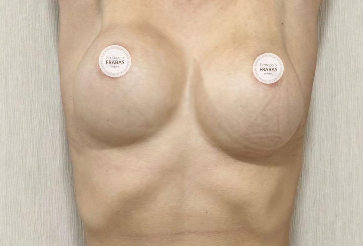 Antes de la cirugía: implantes previos con asimetría